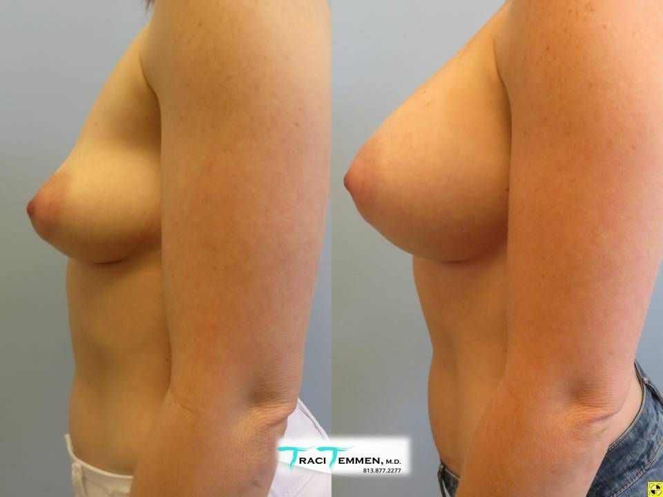 Breast Augmentation Before & After