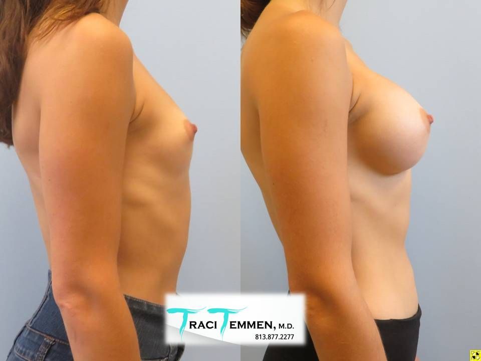 Breast Augmentation Before & After