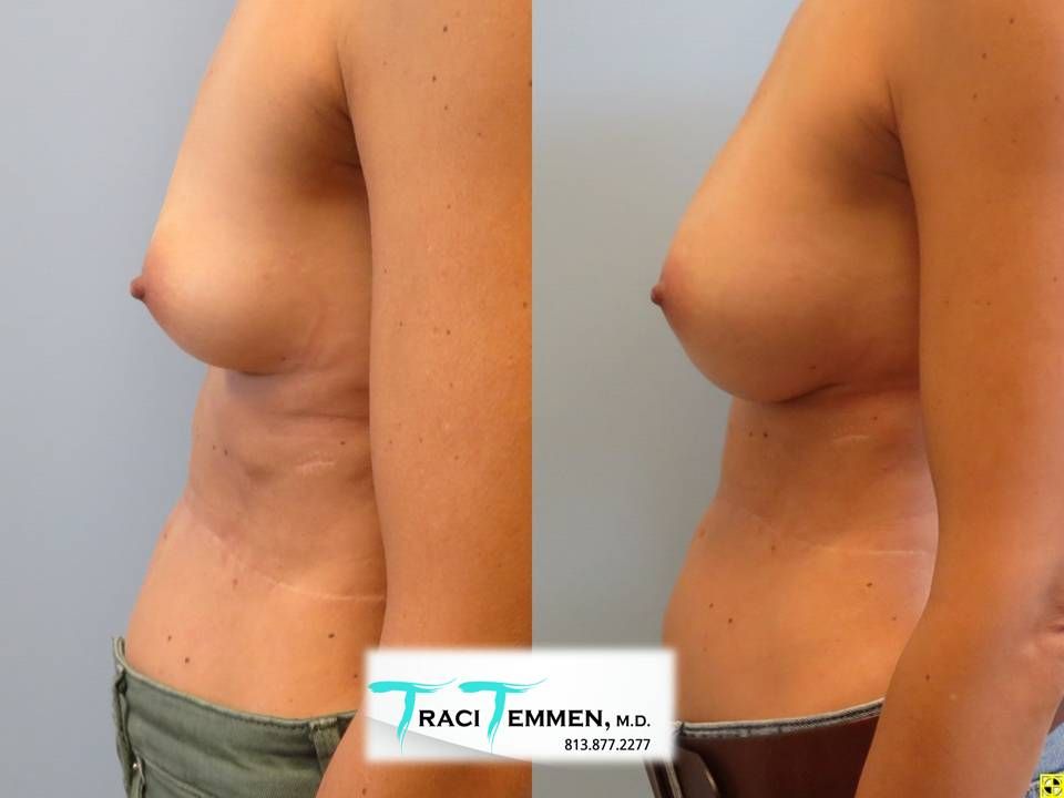Breast Augmentation Before & After