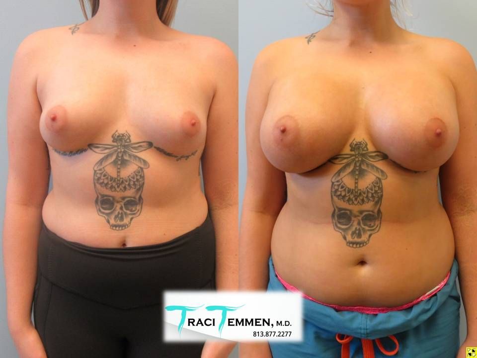 Breast Augmentation Before & After