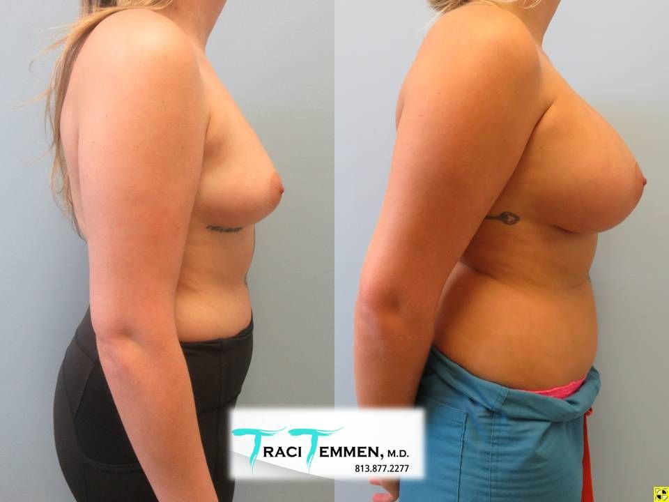 Breast Augmentation Before & After