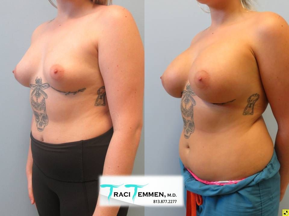 Breast Augmentation Before & After