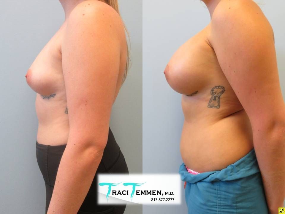 Breast Augmentation Before & After