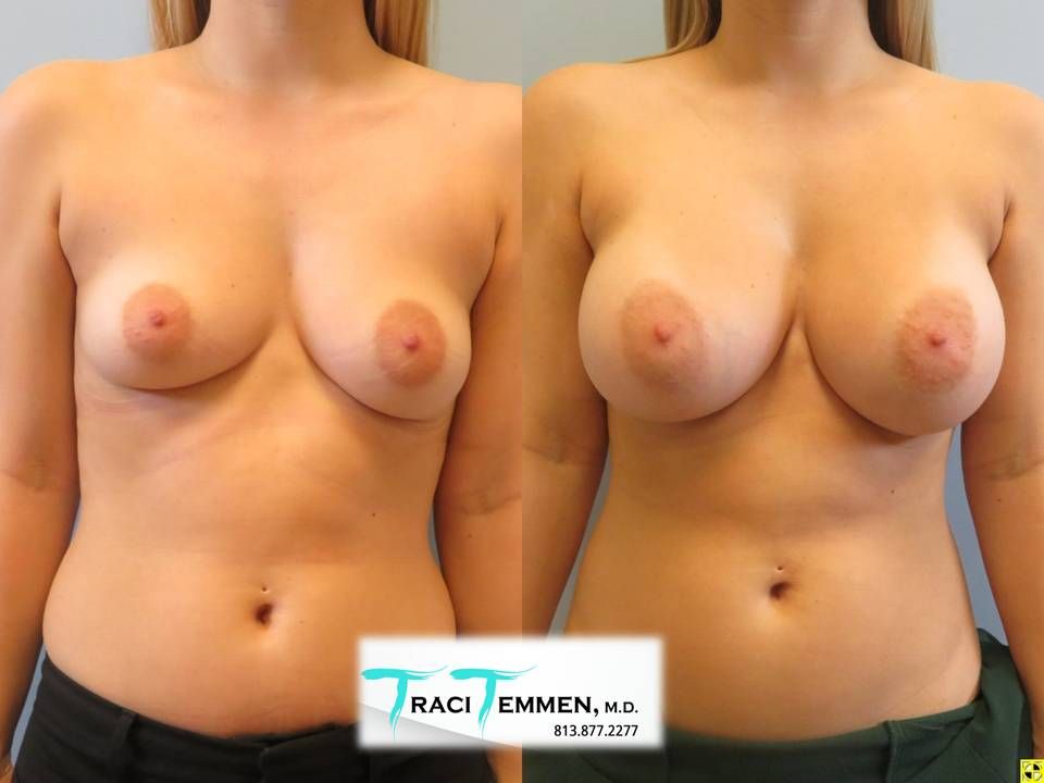 Breast Augmentation Before & After