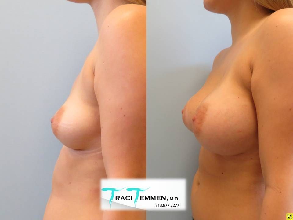Breast Augmentation Before & After
