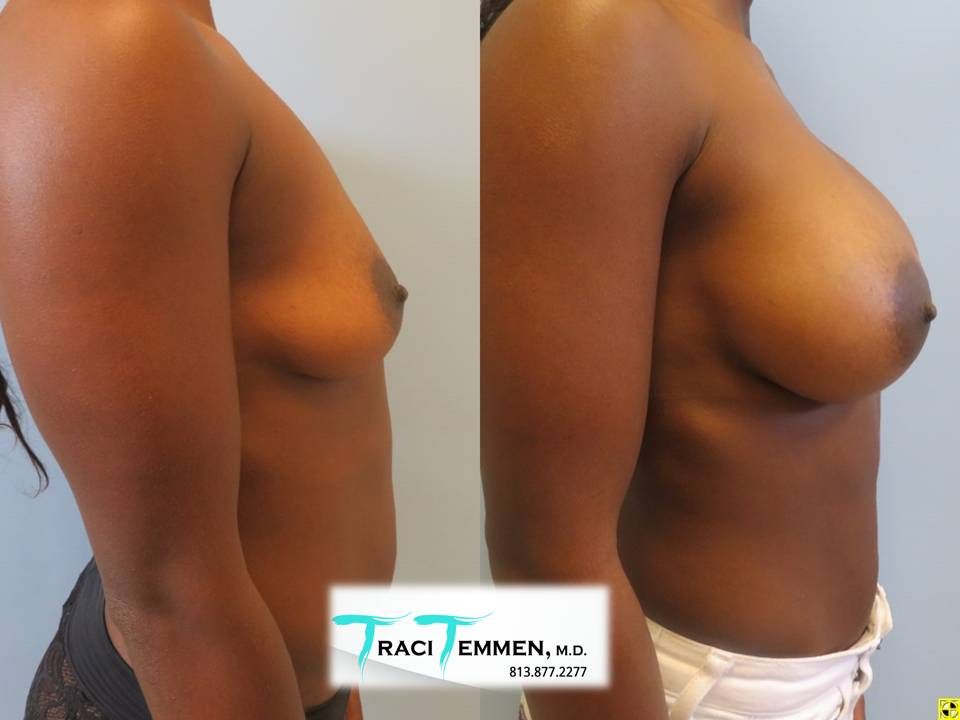 Breast Augmentation Before & After