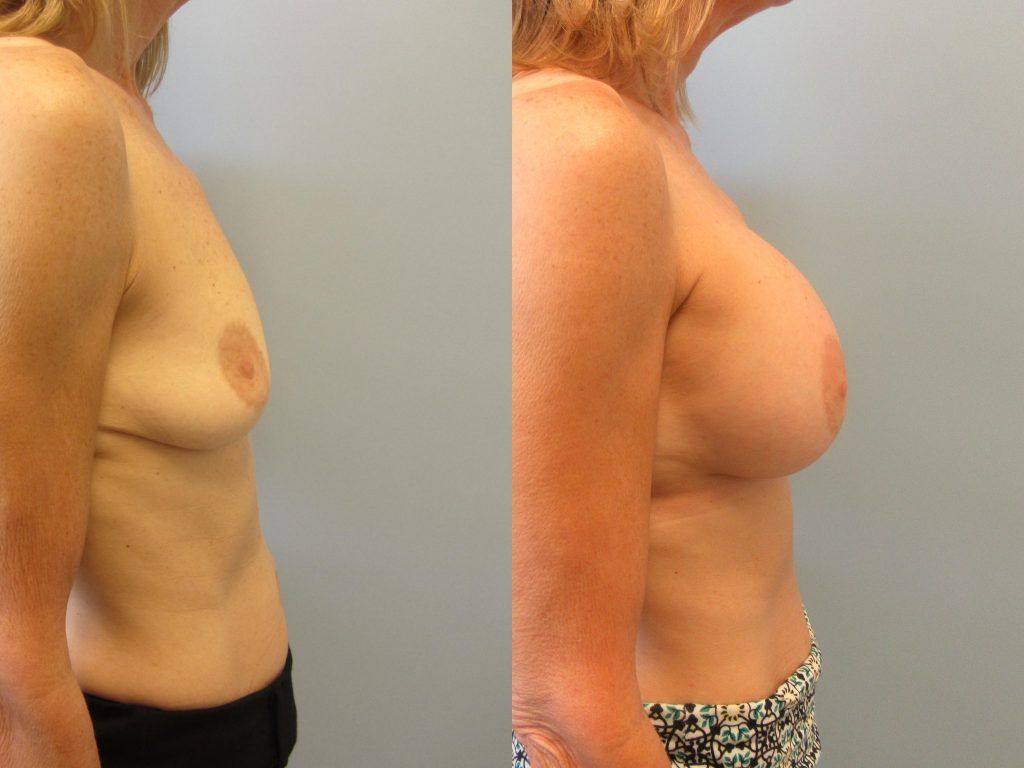 Breast Augmentation Before & After