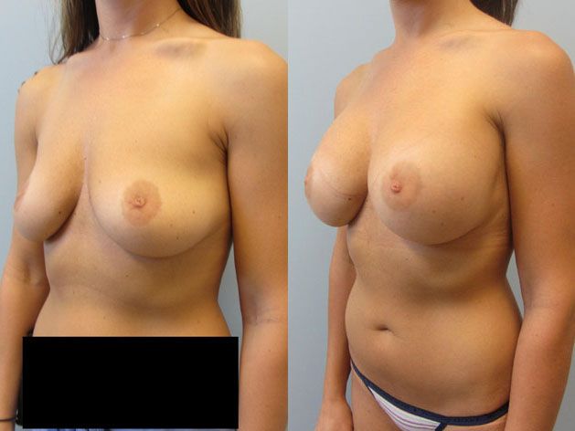 Breast Augmentation Before & After