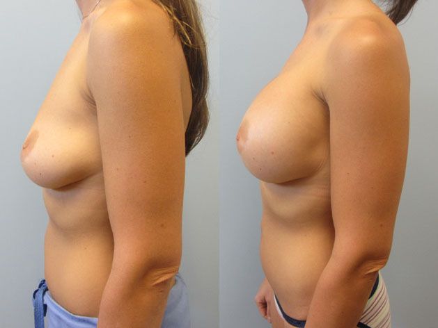 Breast Augmentation Before & After
