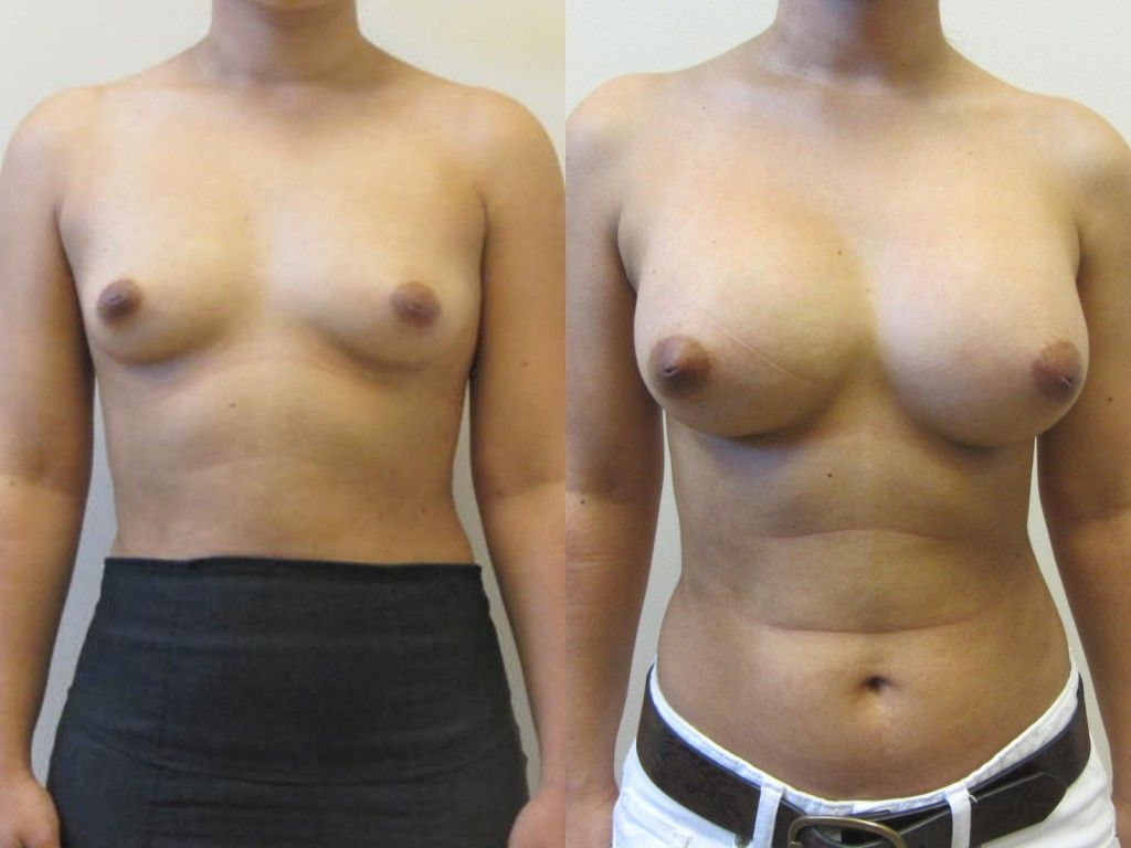 Breast Augmentation Before & After