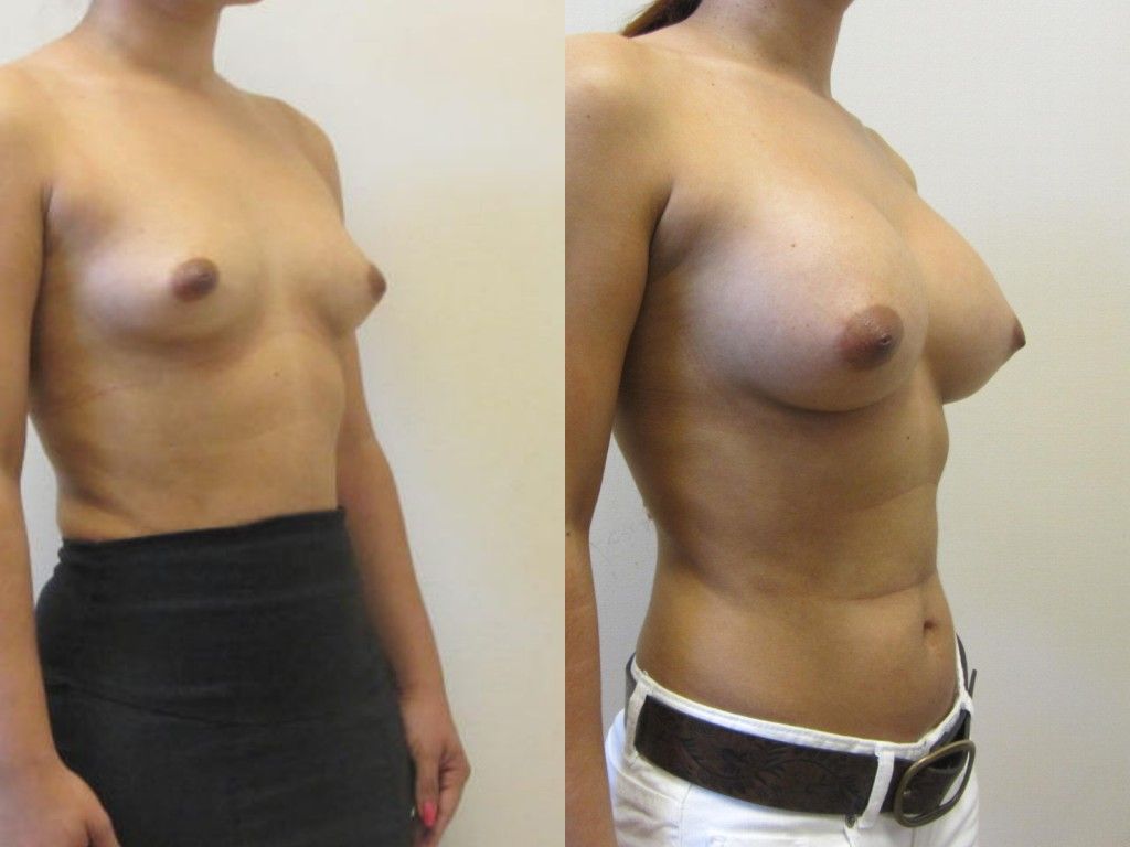 Breast Augmentation Before & After