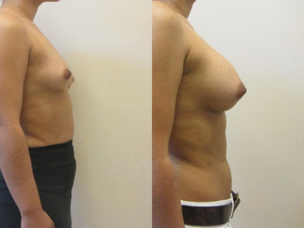 Breast Augmentation Before & After