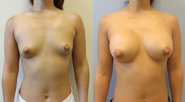 Breast Augmentation Before & After