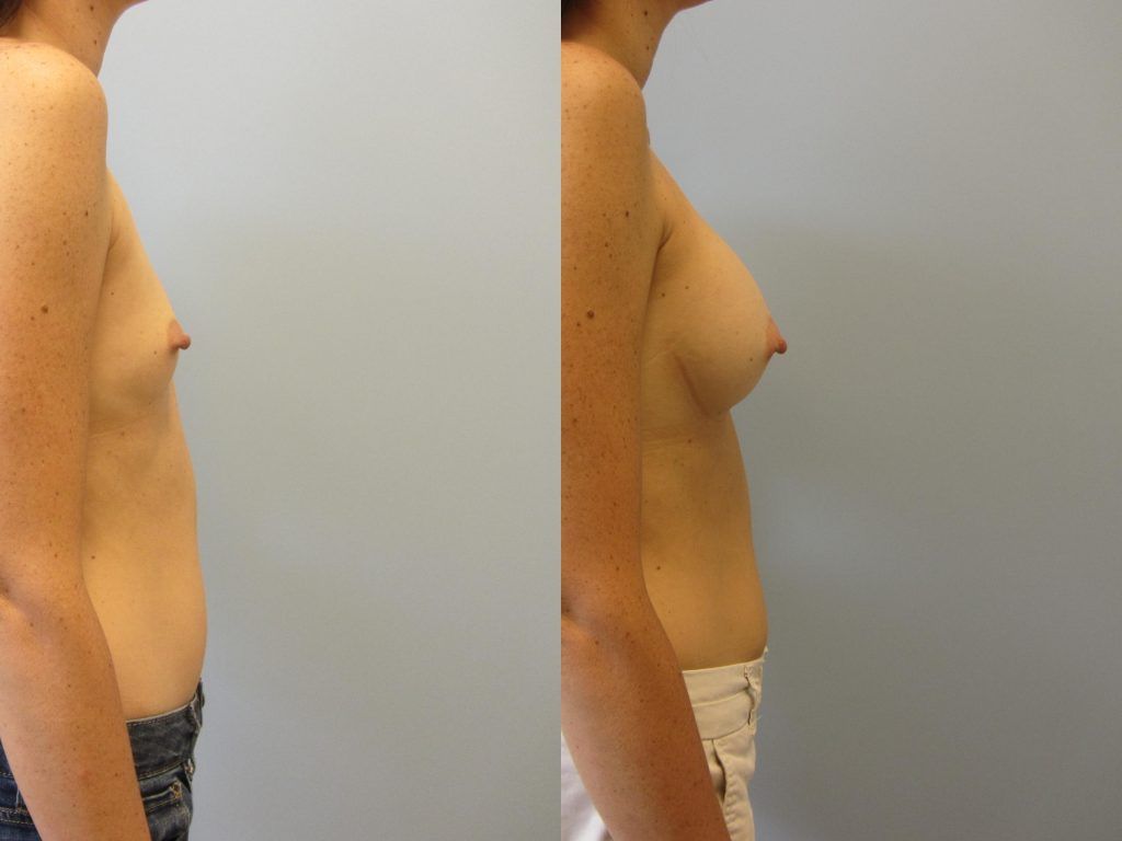 Breast Augmentation Before & After