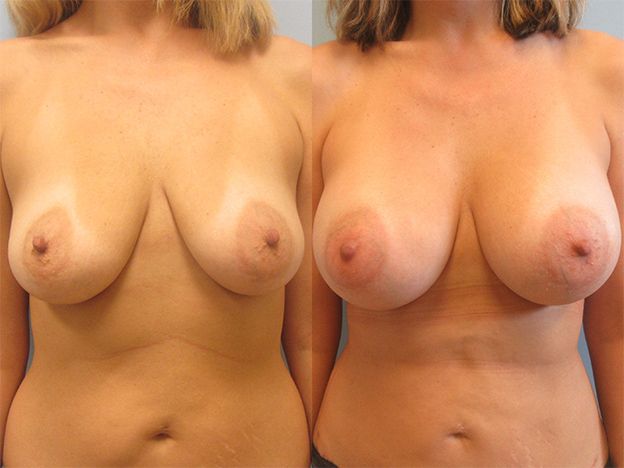 Breast Augmentation Before & After
