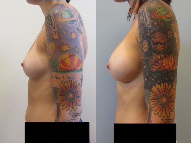 Breast Augmentation Before & After