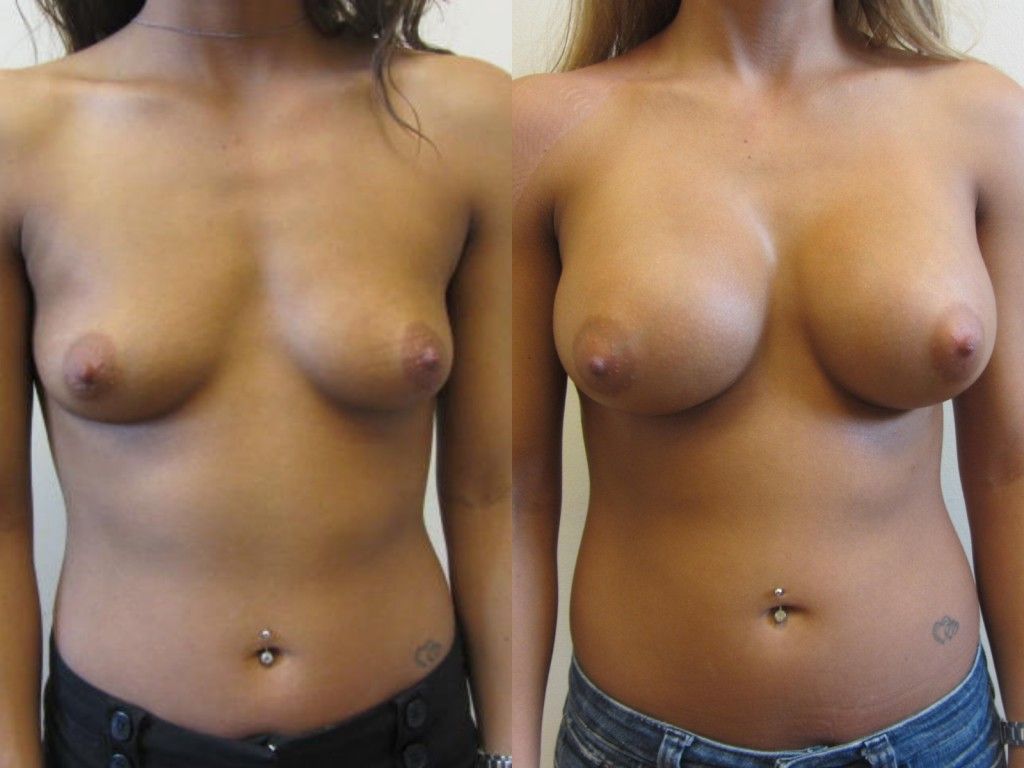 Breast Augmentation Before & After