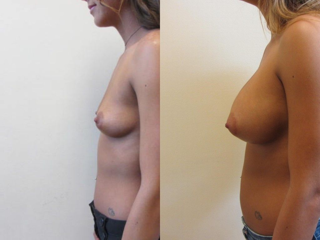 Breast Augmentation Before & After