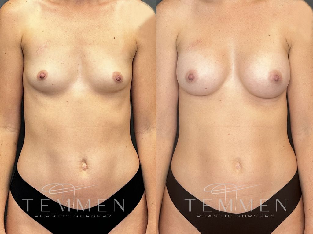 Breast Augmentation Before & After