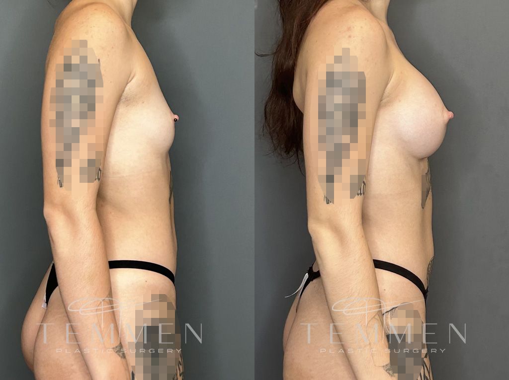 Breast Augmentation Before & After