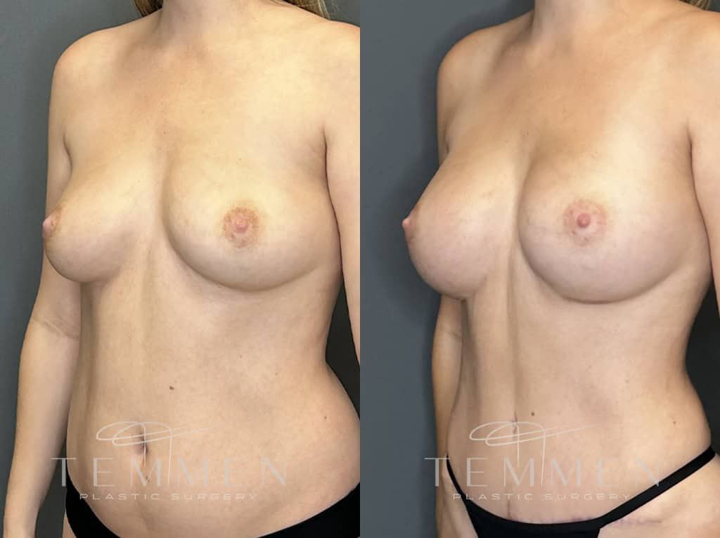 Breast Augmentation Before & After