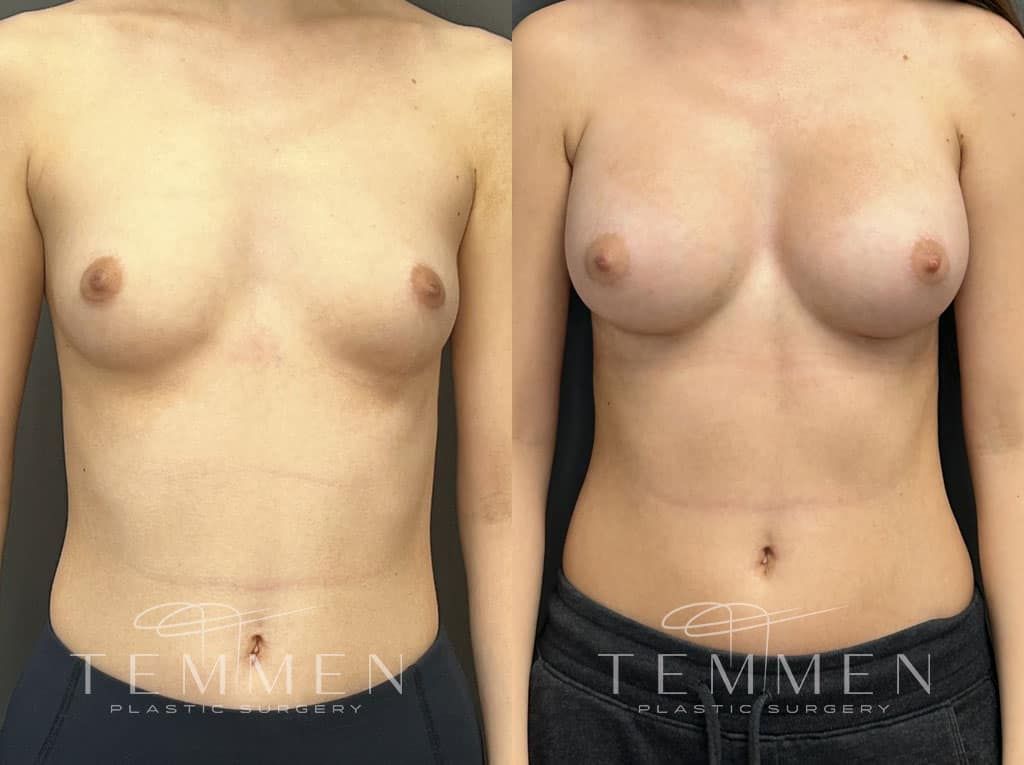 Breast Augmentation Before & After