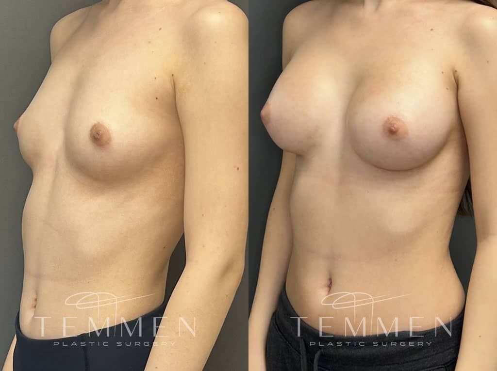 Breast Augmentation Before & After