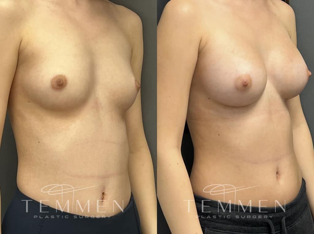 Breast Augmentation Before & After