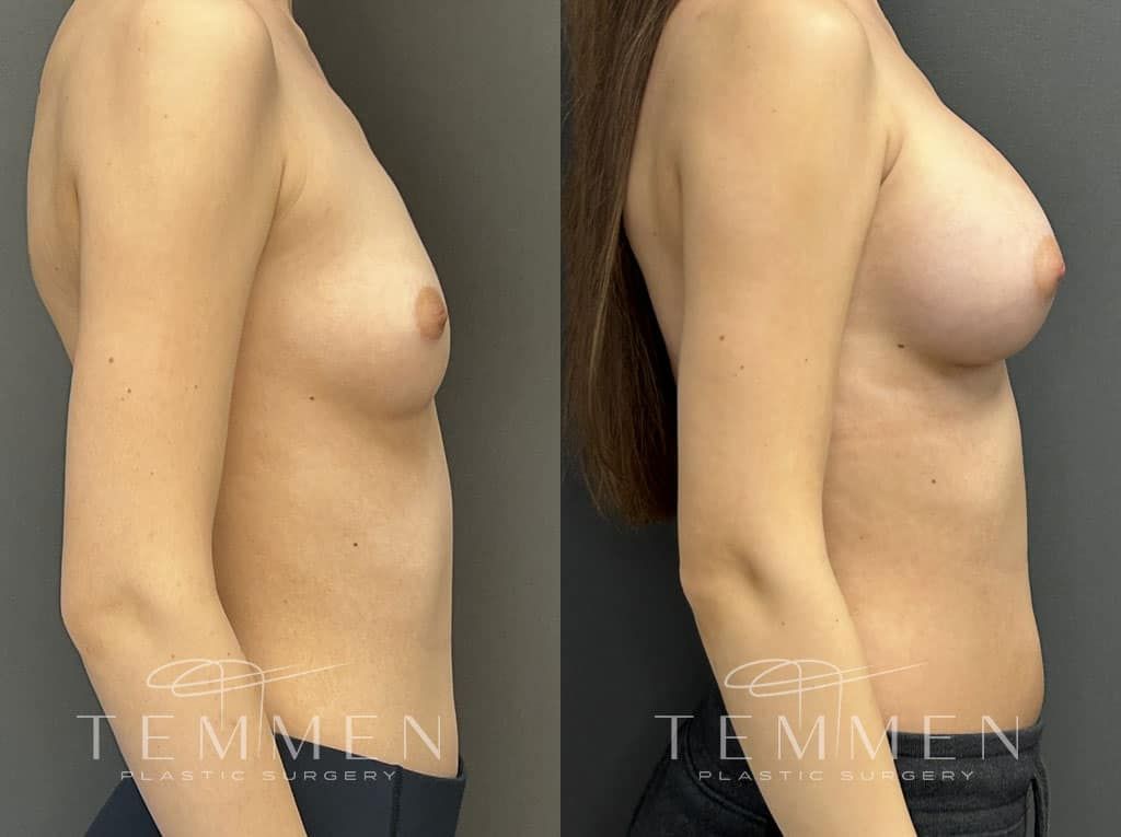 Breast Augmentation Before & After