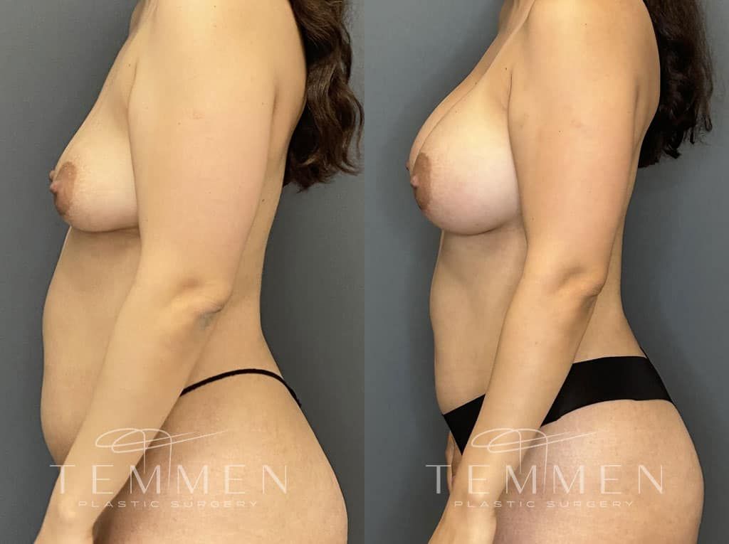 Breast Augmentation Before & After
