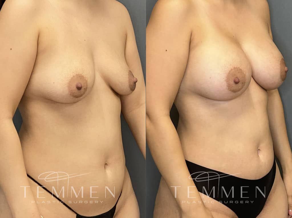 Breast Augmentation Before & After