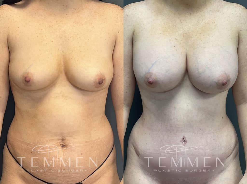 Breast Augmentation Before & After