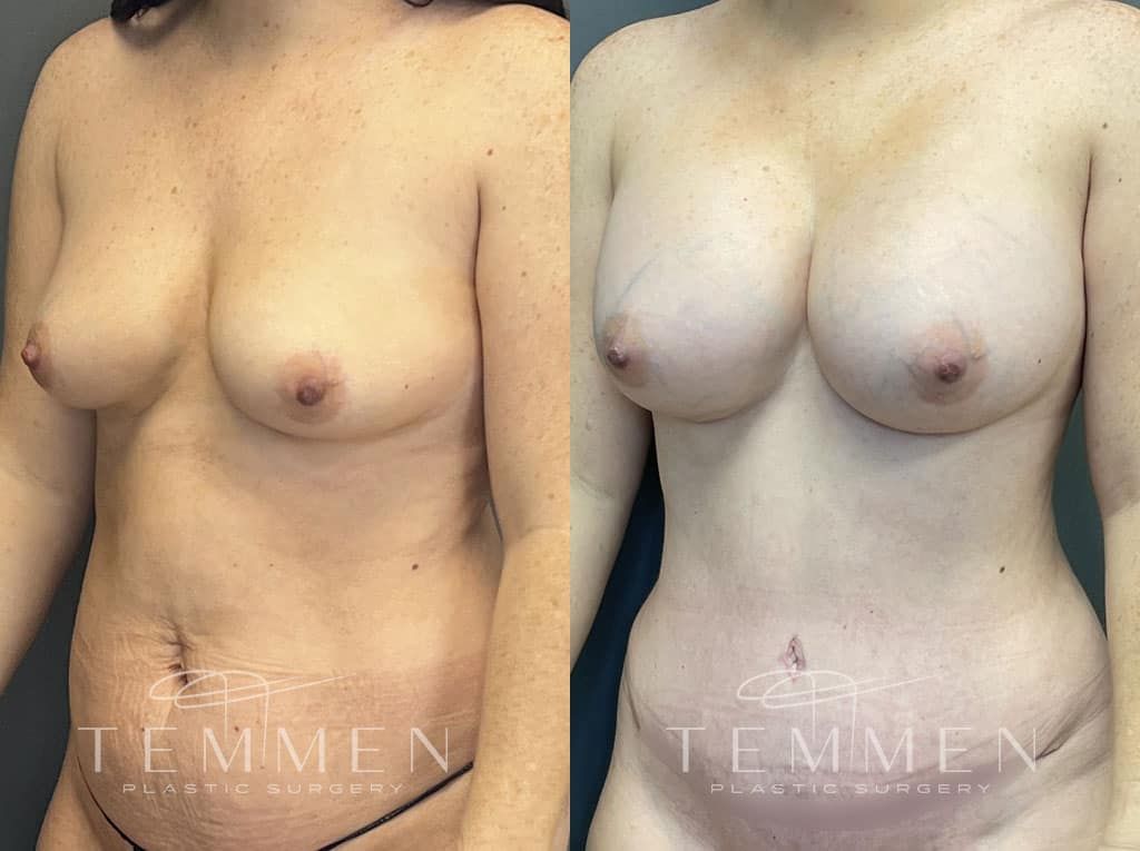 Breast Augmentation Before & After