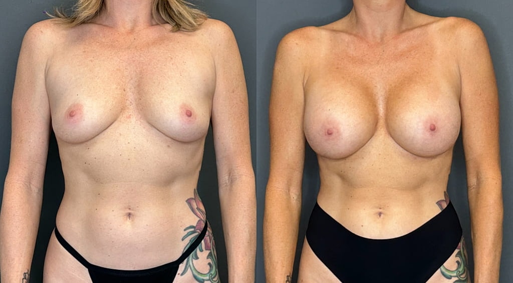 Breast Augmentation Before & After