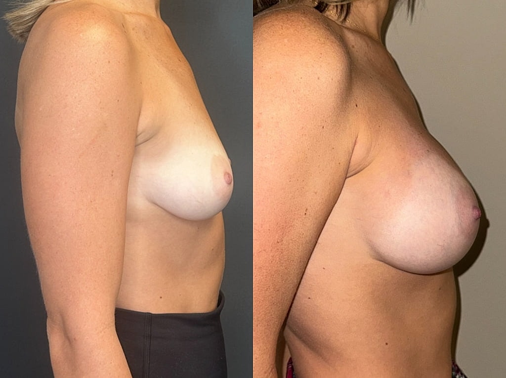 Breast Augmentation Before & After