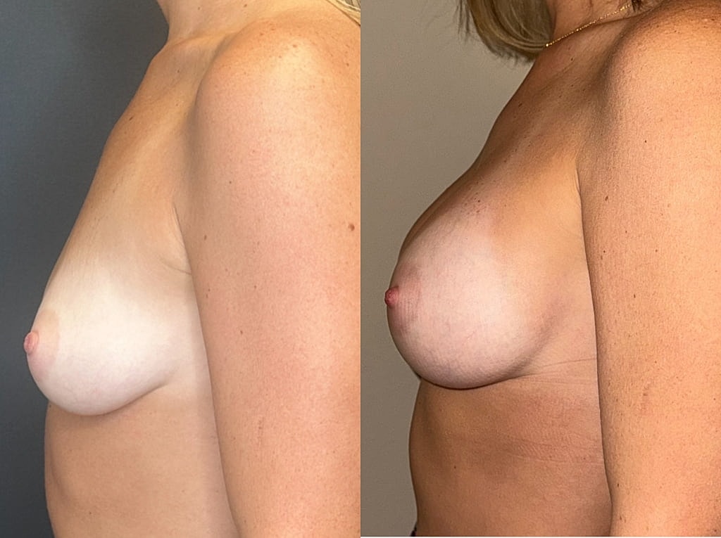 Breast Augmentation Before & After