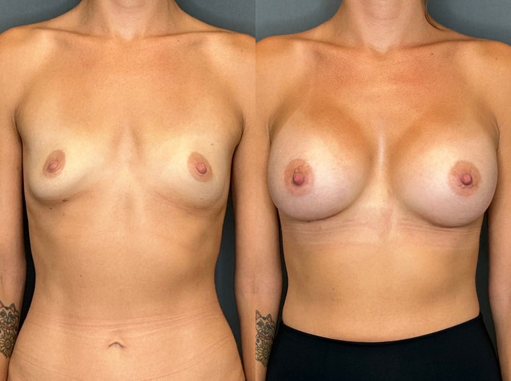 Breast Augmentation Before & After