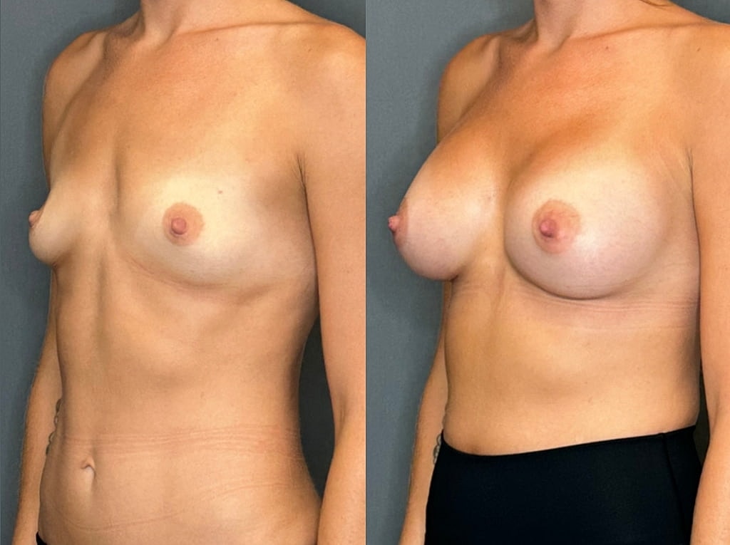 Breast Augmentation Before & After