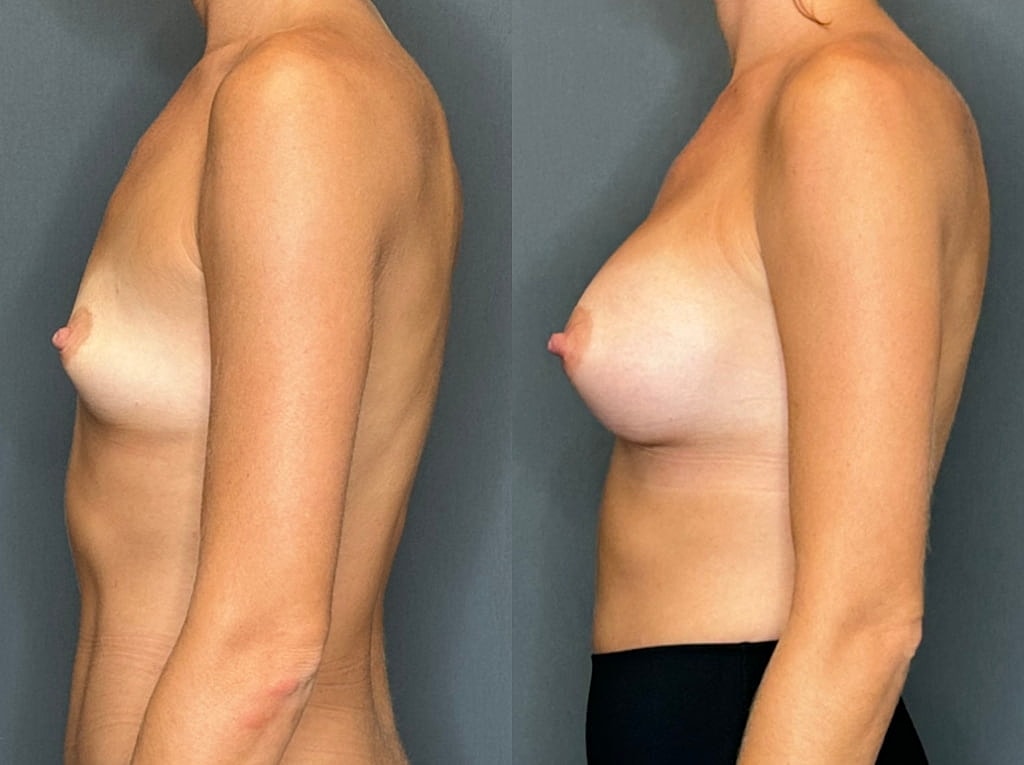 Breast Augmentation Before & After