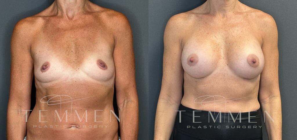 Breast Augmentation Before & After
