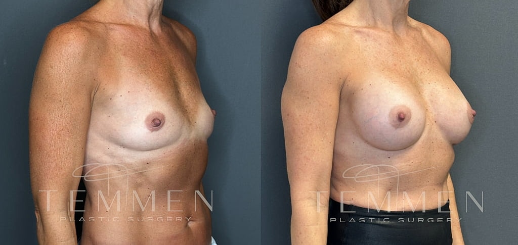 Breast Augmentation Before & After