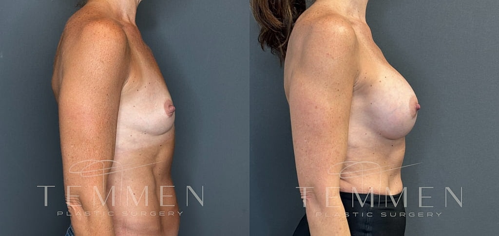 Breast Augmentation Before & After
