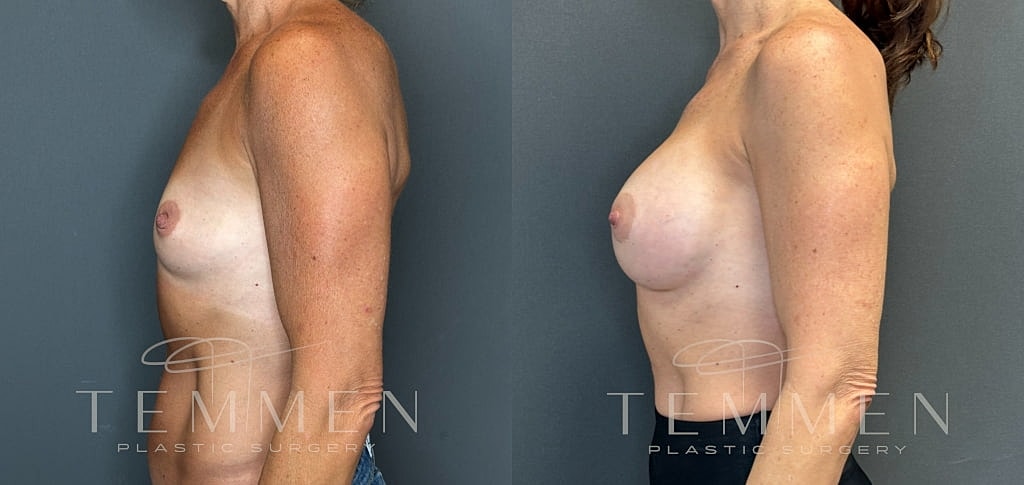 Breast Augmentation Before & After