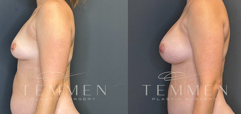 Breast Augmentation Before & After