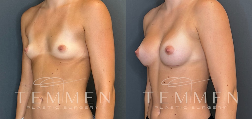 Breast Augmentation Before & After