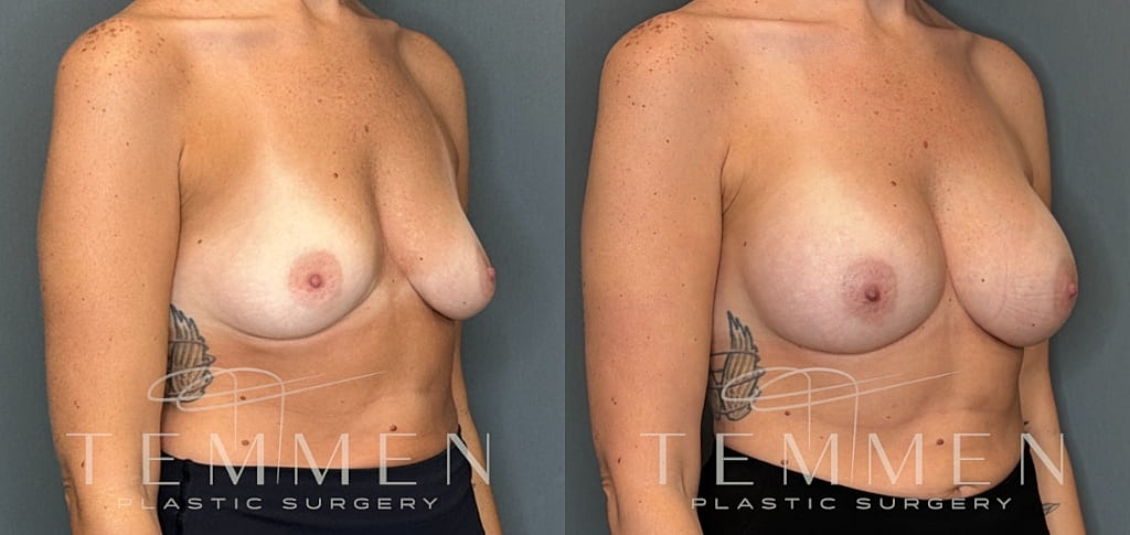 Breast Augmentation Before & After
