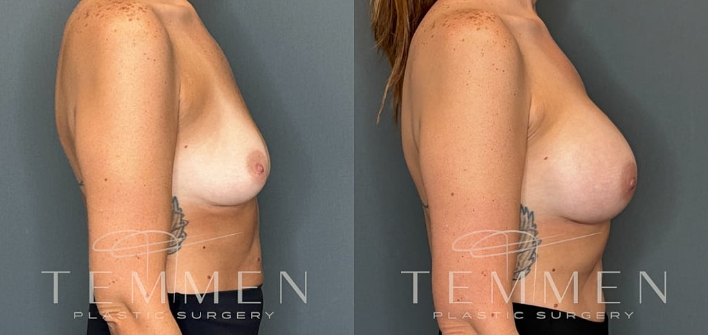Breast Augmentation Before & After