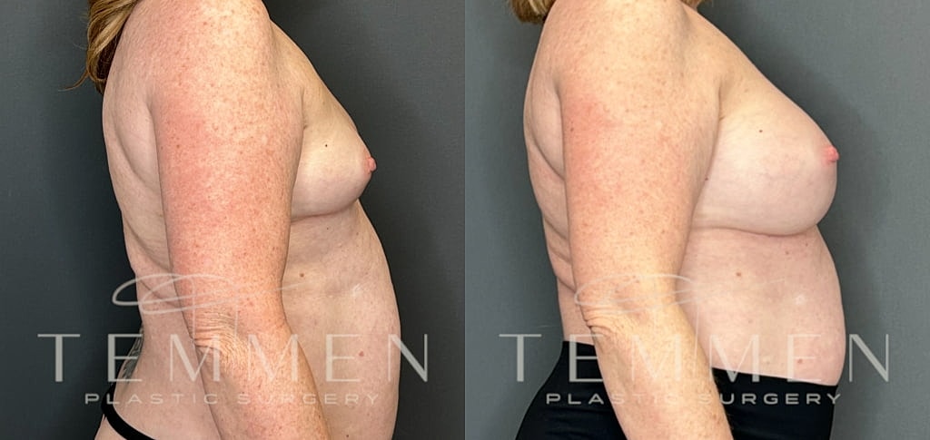 Breast Augmentation Before & After
