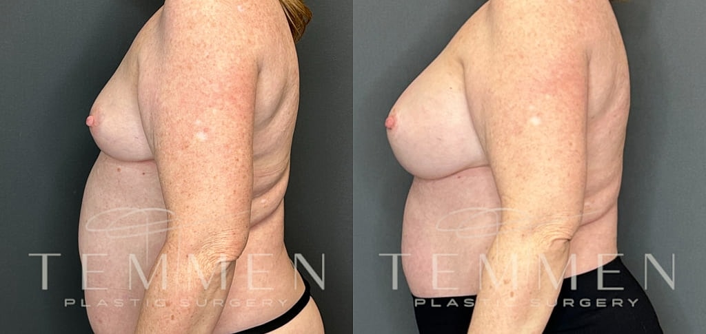Breast Augmentation Before & After