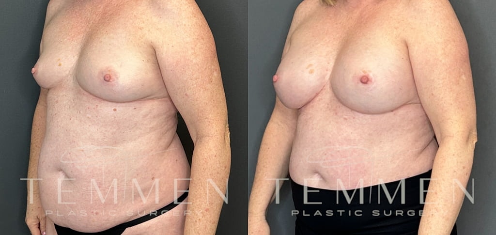 Breast Augmentation Before & After